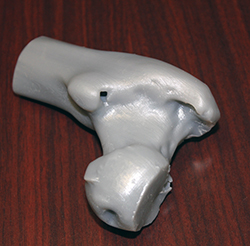 The head of the human femur prototyped by Christina Merritt, Brinda Shah and David Wagura using the Form 1+ SLA Printer by Formlabs.